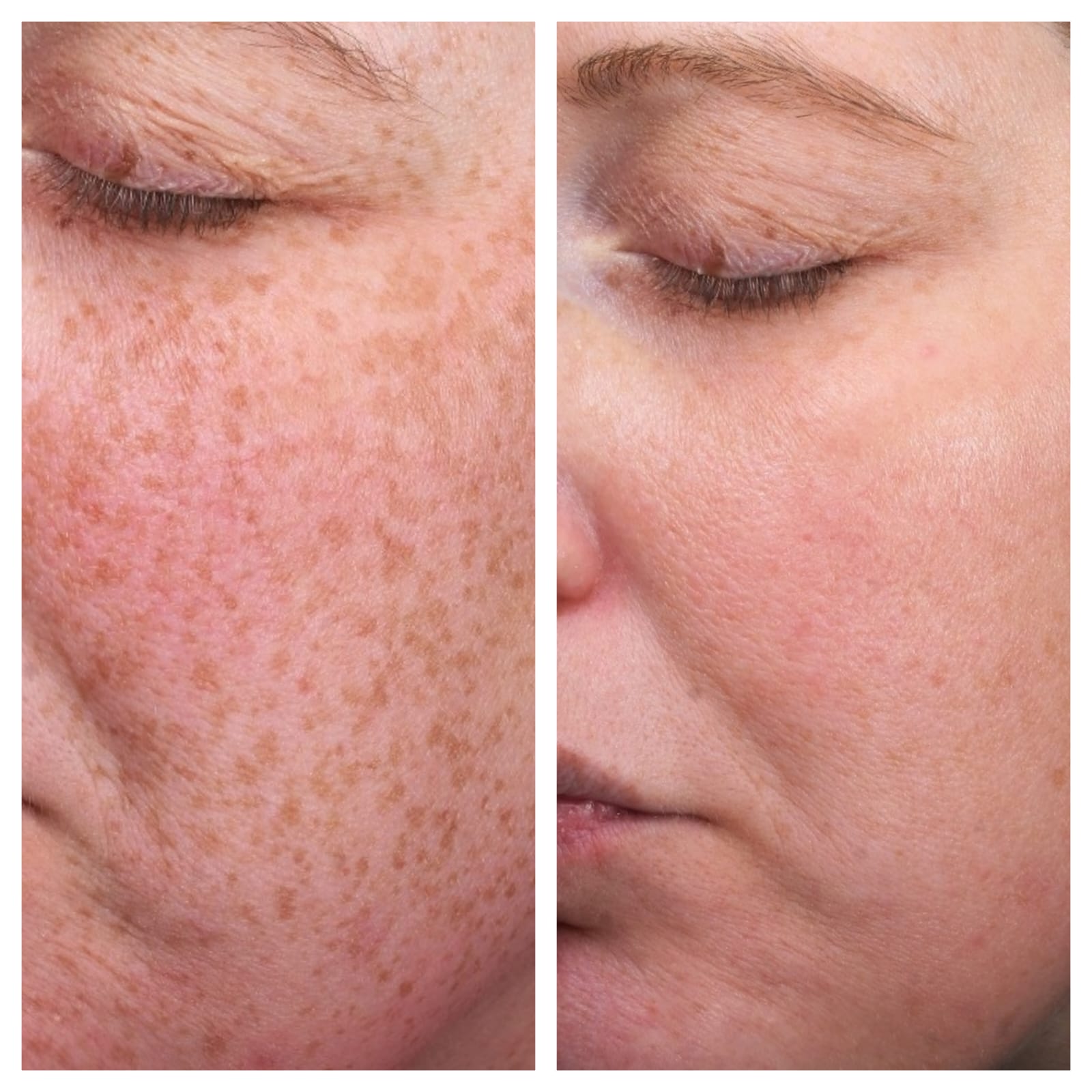 IPL 2 zones 10% korting