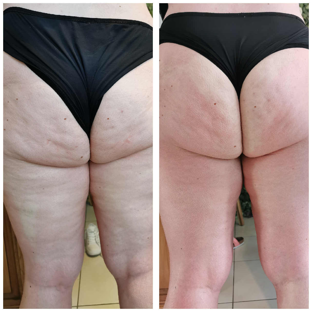 Cellulite Mesoestetic Bodyshock